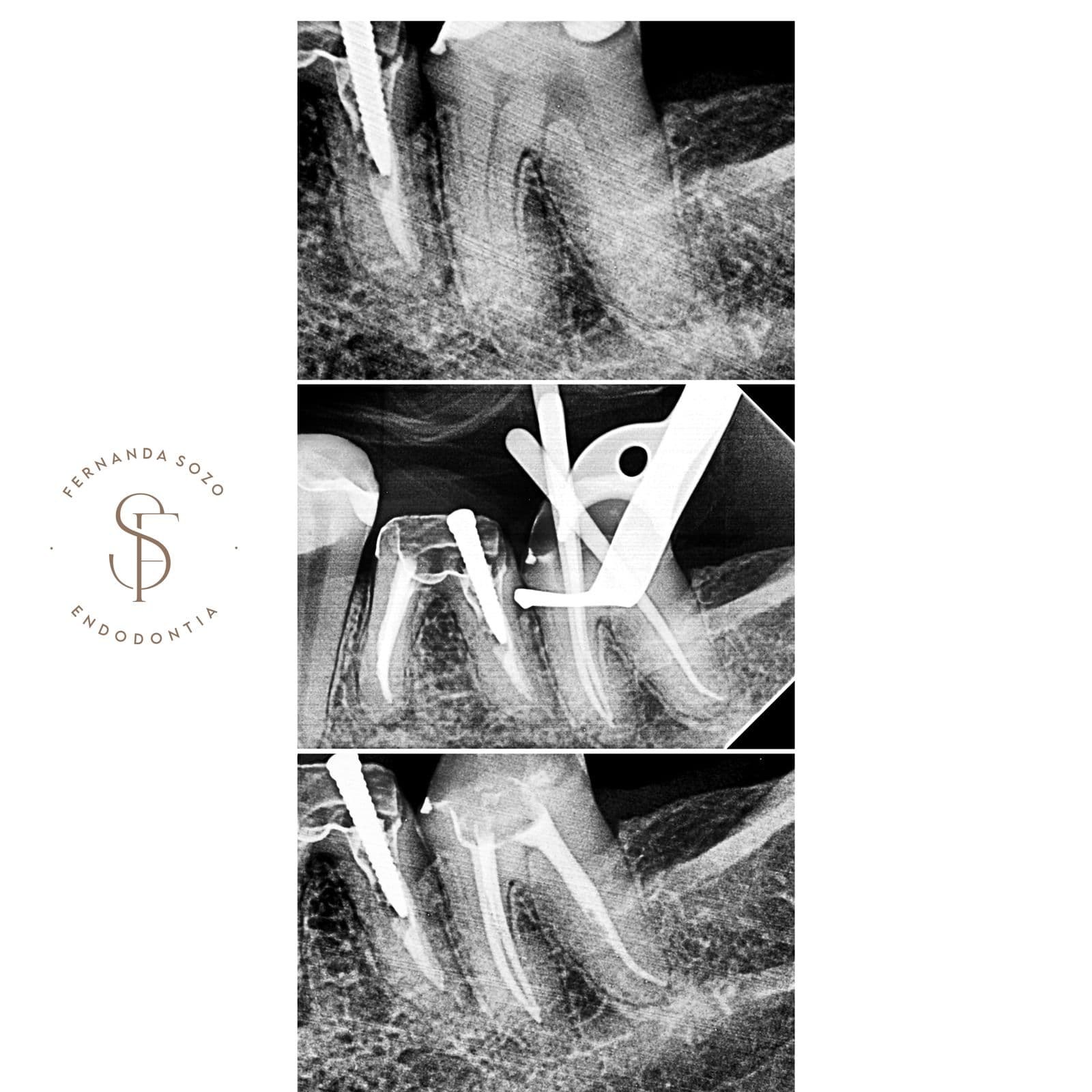 Tratamento de canal em molar com raiz dilacerada