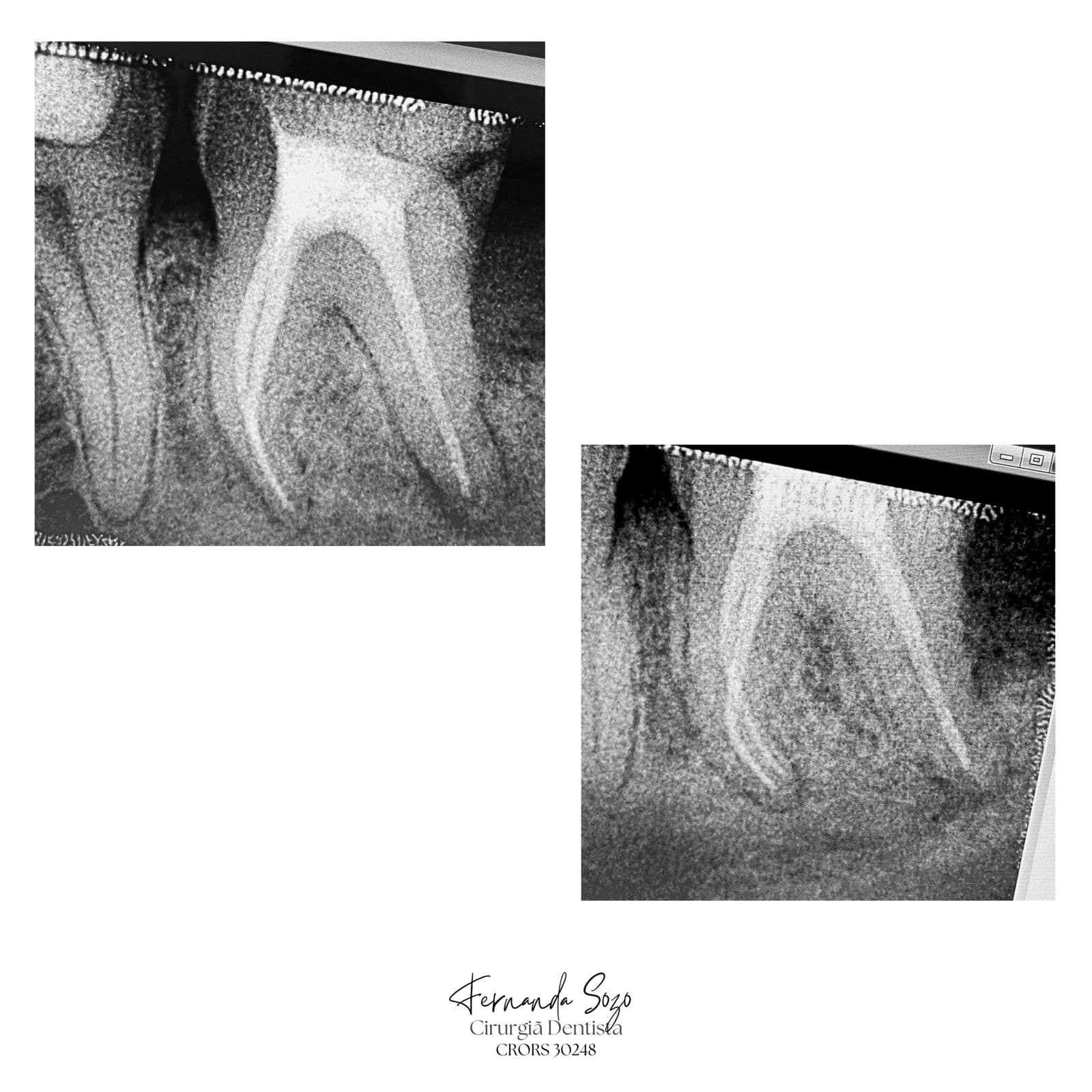 Retratamento endodôntico com lesão periapical extensa