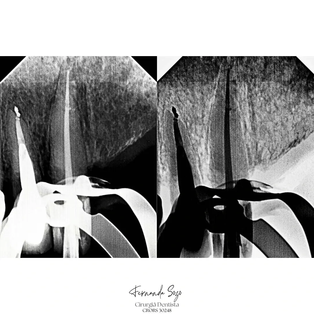 Endodontia de incisivo central com lesão periapical