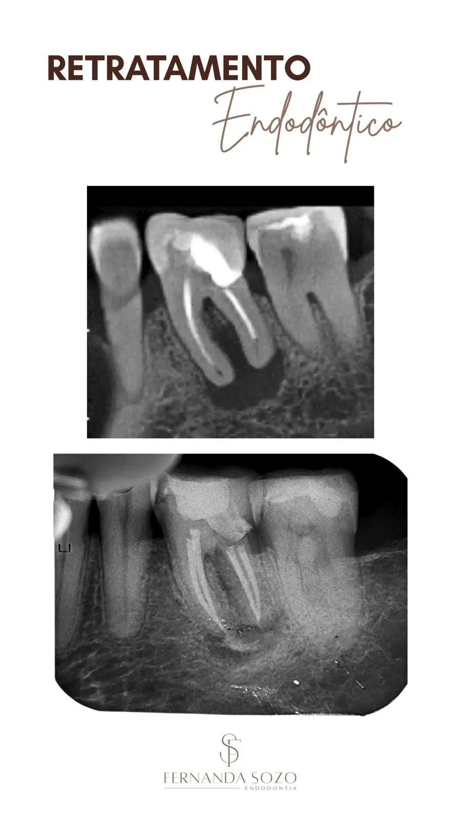 Endodontia de pré-molar inferior com dois canais